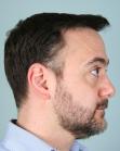 After Hair Transplant&nbsp;Front